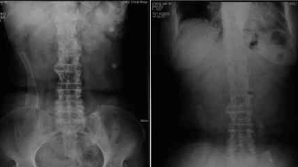 第3例  直乙交界肿瘤多发转移后直肠支架堵塞