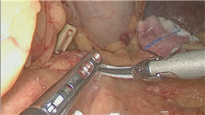 腹腔镜辅助根治性全胃切除术（含腹腔镜D2淋巴结清扫术）