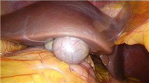 右肝8段切除术