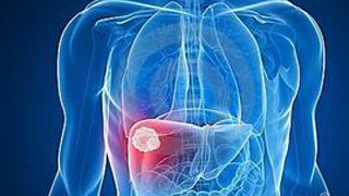 结肠癌肝单发转移瘤术后处理