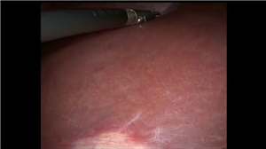 乳腺癌肝转移病例腹腔镜右半肝切除