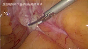 腔镜辅助下扩大右半结肠切除术