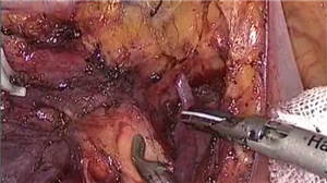 腹腔镜右半结肠切除术