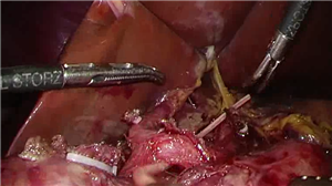 联合SMV切除重建的腹腔镜胰十二指肠切除术
