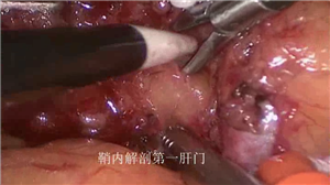 腹腔镜前入路右半肝切除术
