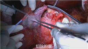 右半肝切除+尾状叶切除+肝后下腔静脉重建右肾静脉重建术