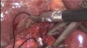 腹腔镜扩大左半肝联合部分尾状叶切除治疗小肝癌