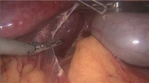 前入路腹腔镜右半肝切除术