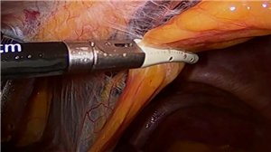 腹腔镜下解剖性右半肝切除术