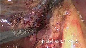 免吻合器腹腔镜下解剖性右半肝切除术