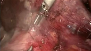 血管为导向的腹腔镜右半肝切除术