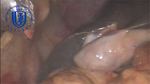 异位肝总动脉腹腔镜胰十二指肠切除术