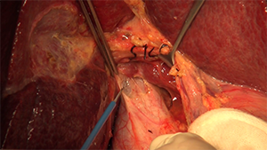 HCC前入路右半肝切除联合扩大清扫术术后淋巴瘘诊治体会
