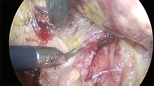 荧光导航腹腔镜肝Ⅷ段切除术