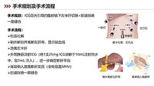 ICG荧光引导的腹腔镜下解剖性左半肝切除术