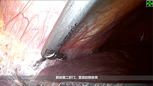 荧光腹腔镜引导的肝脏解剖性S8v+S4切除术