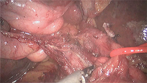 腹腔镜下肝门胆管癌根治术（Bismuth Ⅲb型：左半肝+全尾叶切除+肝门淋巴结清扫+胆肠内引流术）