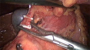 腹腔镜下保留十二指肠的胰头切除术