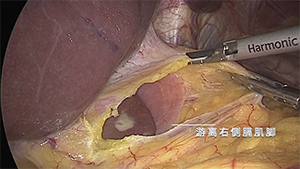 全腹腔镜下根治性全胃切除术，Overlap SPLT吻合