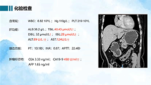 腹腔镜下肝门胆管癌根治术