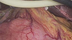 腹腔镜下头背侧入路左半肝切除+胆道探查术