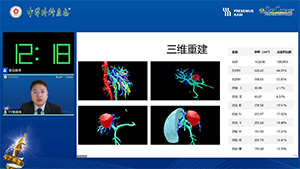荧光腹腔镜下解剖性左半肝切除术