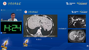 腹腔镜下IIIa型肝门部胆管癌根治术