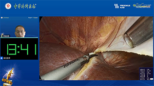 腹腔镜荧光引导下解剖性右后叶及尾状突切除术