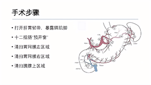 腹腔镜远端胃癌根治术