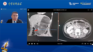“翻页式”清扫胰腺上区淋巴结--腹腔镜远端胃癌根治术