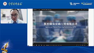 腹腔镜保留幽门胃癌根治术